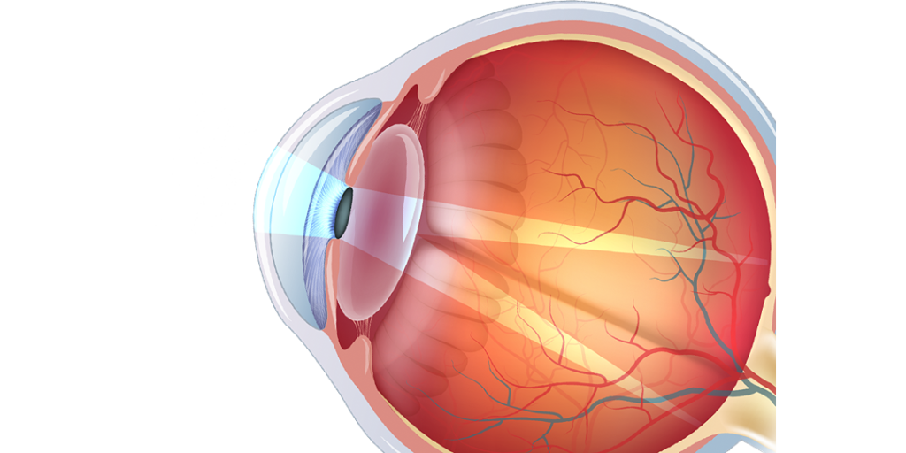 How Astigmatism Affects Vision