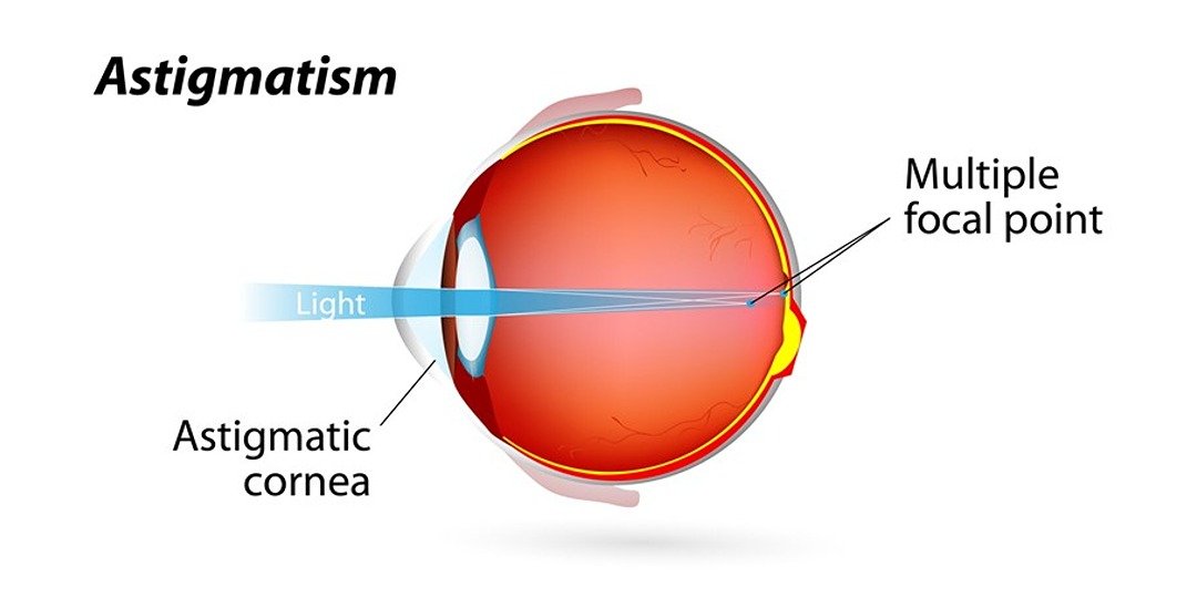What is Astigmatism? Can I Wear Normal Contact Lenses with it? Baniyas Optics