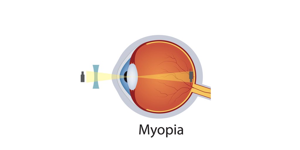 Myopic Astigmatism