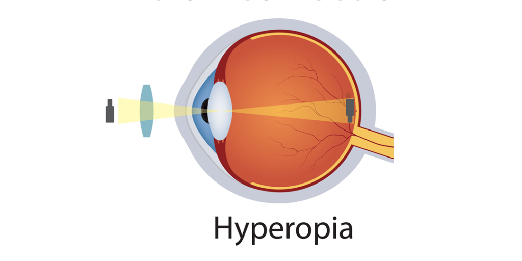 Hyperopic Astigmatism