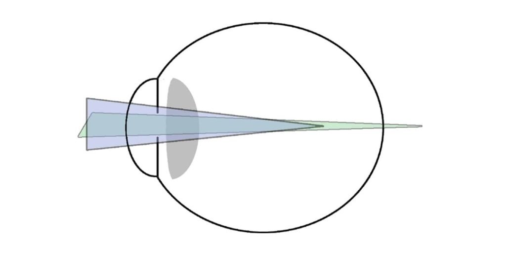 Mixed Astigmatism